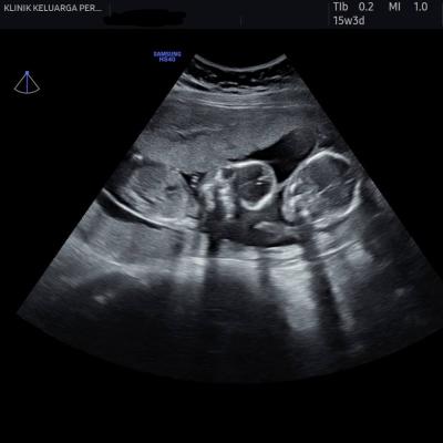 Imbasan Ultrabunyi Kehamilan 10