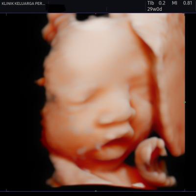 Imbasan Ultrabunyi Kehamilan 3