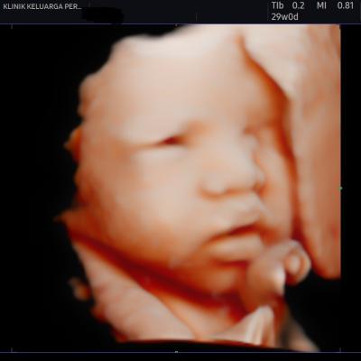 Imbasan Ultrabunyi Kehamilan 5