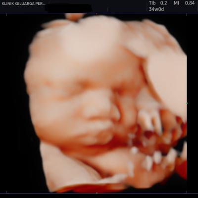 Imbasan Ultrabunyi Kehamilan 6