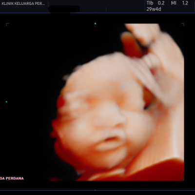 Imbasan Ultrabunyi Kehamilan 7