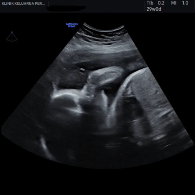 Imbasan Ultrabunyi Kehamilan 8
