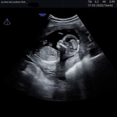 Imbasan Ultrabunyi Kehamilan 9